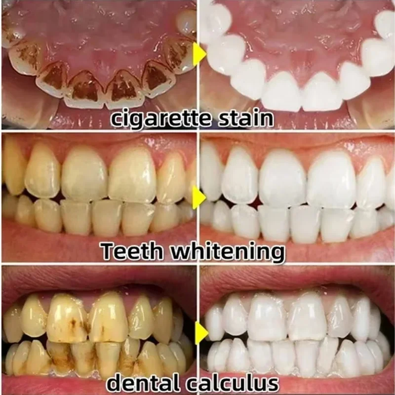 すぐに修復ガム血清後退する歯茎の再成長を和らげるドロップ歯を - Teeth Whitening Baking Soda のレビューと価格