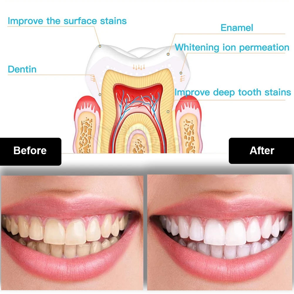 歯科歯ホワイトニングキットミニ 16 LED コールドライト - Teeth Whitening Zoom のレビューと価格