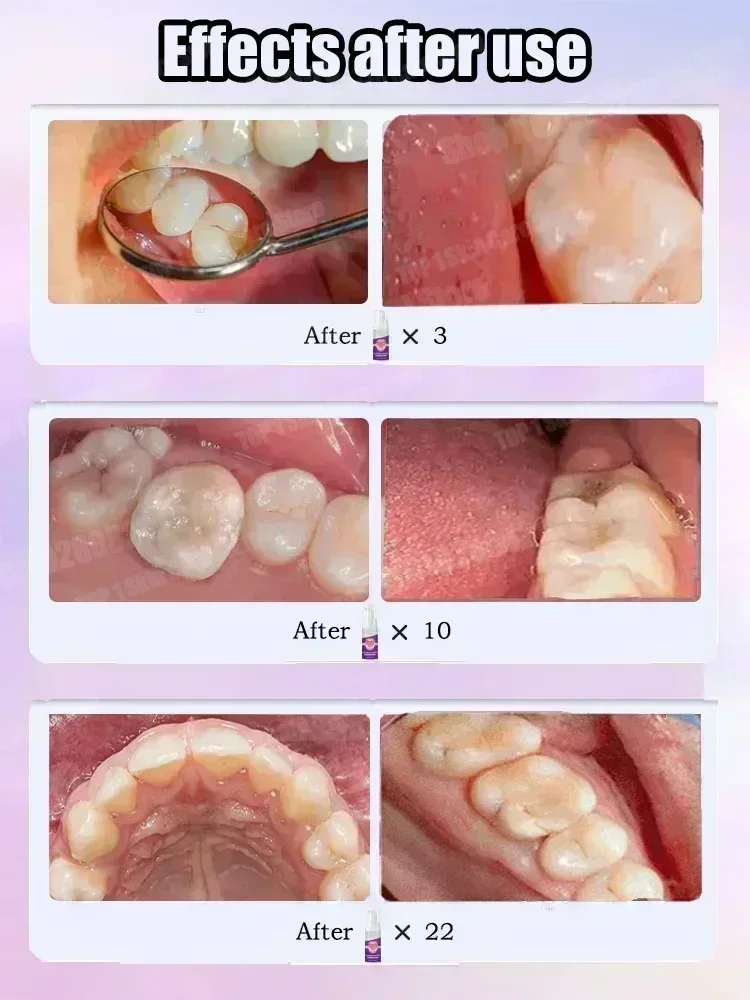 ホットセールのベストセラー、科学的修復虫歯、虫歯の除去、歯垢 - Teeth Whitening Best のレビューと価格